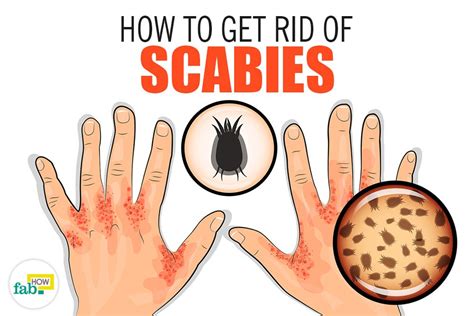 How To Get Rid Of Scabies With Home Remedies Fab How