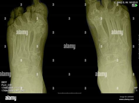 Feet X Ray Of An 83 Year Old Male Patient Suffering From Rheumatoid