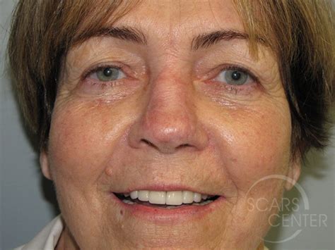 Nose Reconstruction 6 Skin Cancer And Reconstructive Surgery Center