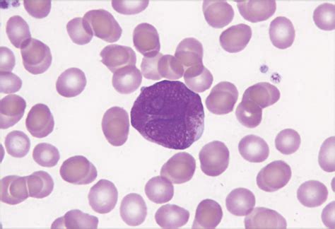 Epistaxis Ecchymoses And An Abnormal White Blood Cell Count