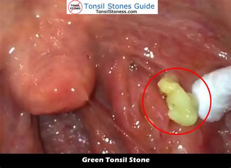 Best Tonsil Stones Images And Videos