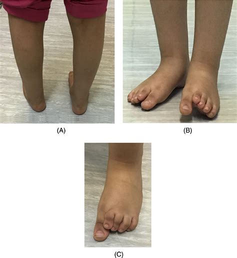 Nonsyndromic Massive Tarsal And Tarsometatarsal Coalitions In A Young