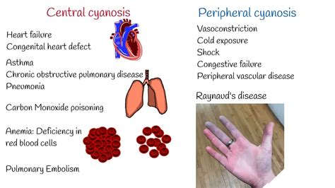Cyanosis Symptoms And Causes Central And Peripheral Cyanosis Youtube
