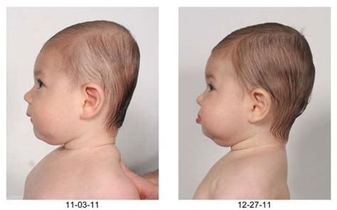 The Baby With A Flat Head How To Reverse The Rising Tide Of Plagiocephaly