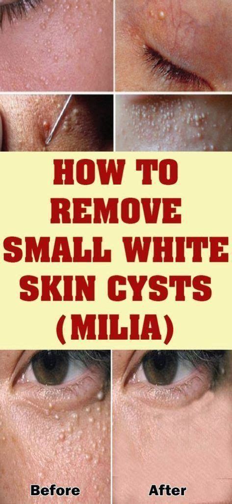 Milia Is A Group Of White Small Solid Keratin Filled Cysts Skin