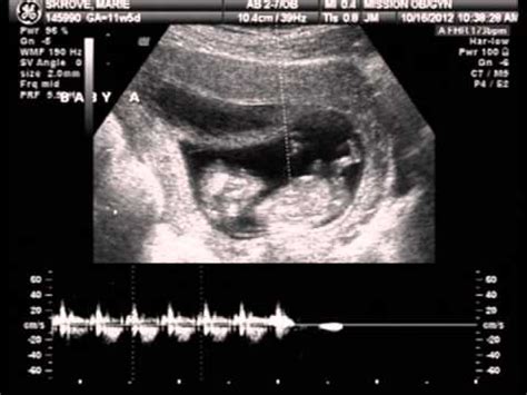 Dating scans also reveal other important information such as: ultrasound 12 weeks, nuchal translucency - YouTube