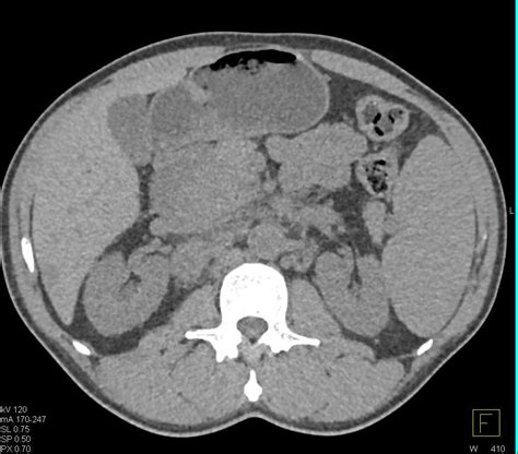 Lymphoma Infiltrates The Head Of The Pancreas And Adrenal Glands And