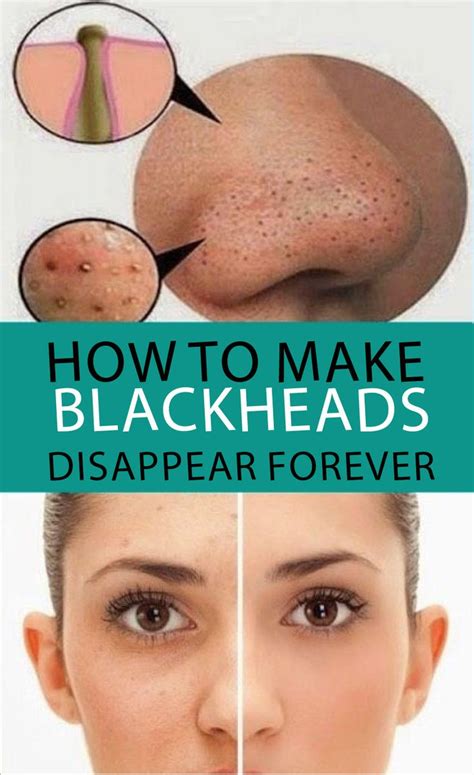 Some Effective Ways For Getting Rid Of Pores And Blackheads On The Face