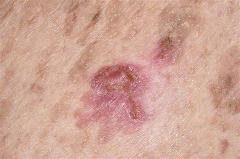 How To Remove Seborrheic Keratosis At Home Escons