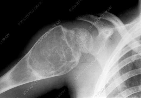 Aneurysmal Bone Cyst X Ray Stock Image C0528212 Science Photo