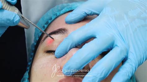 Laser Fotona 4d Rejuvenecimiento Facial Barranquilla Youtube