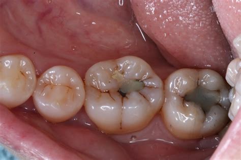 Tooth Decay Molar Treatment