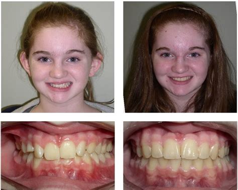 Amazing Results With Our Patients At Egan Orthodontics