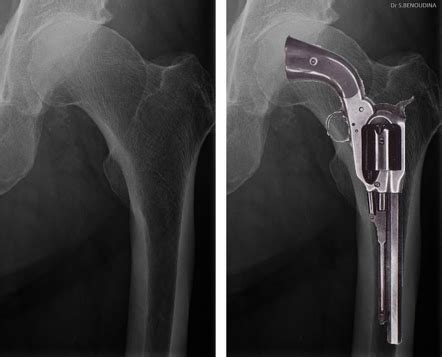Pistol Grip Deformity Hip Radiology Reference Article Radiopaedia Org