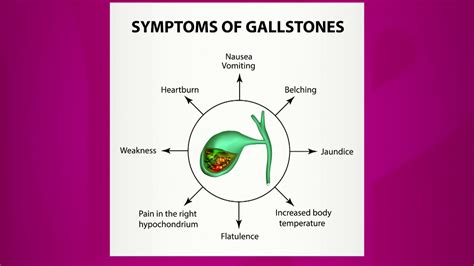 Symptoms Of Gallstones Youtube