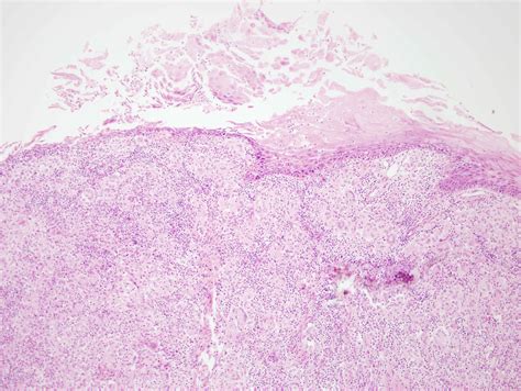 Blastomycosis Causing Laryngeal Leukoplakia Iowa Head And Neck Protocols