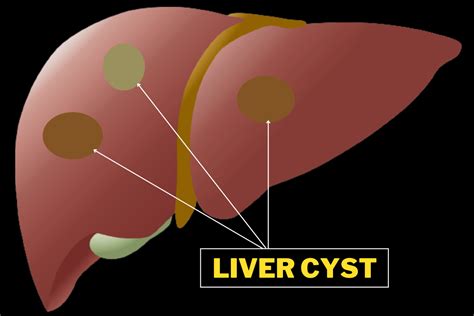 Liver Cyst What Is It How To Prevent And Treat Qpior