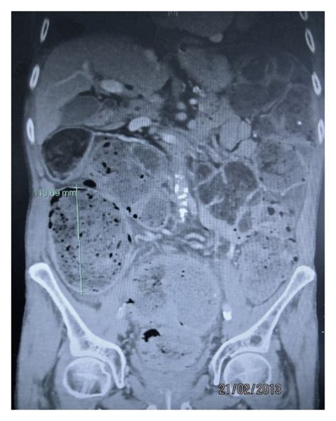 Ct Abdomen And Pelvis Demonstrating Gross Faecal Loading And Colonic