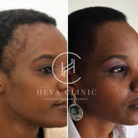 Afro Hair Transplant Before And After Photos Unfiltered Results