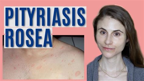 Pityriasis Rosea What It Is And Getting Rid Of It Dr Dray Pityriasis