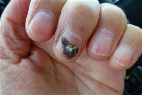 Well, the key to solving the problem is the same for both! Will nails grow back after fingernail fungus? - Nail ...