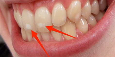 Protect Your Smile From White Spots Oral And Maxillofacial Surgery In San Diego By Mcgann
