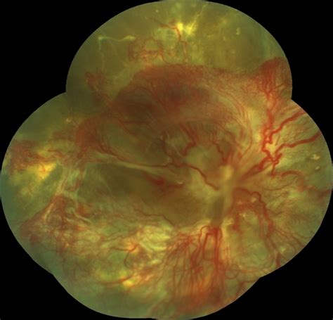 Tractional Retinal Detachment Retina Image Bank