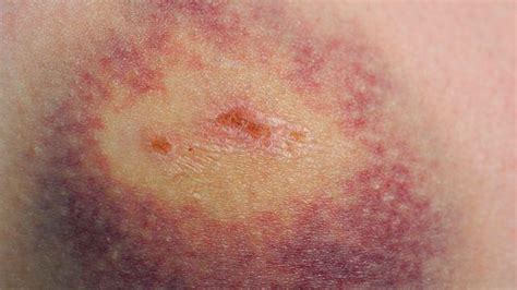 Leukemia Rash Pictures Symptoms And When To See A Doctor