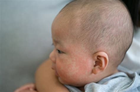Ruam Tiba Tiba Pada Bayi Waspada Dermatitis Atopik