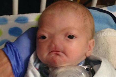Miracle Baby Born Without A Nose In Alabama