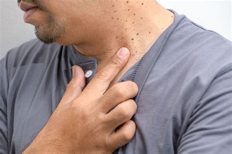 Type 2 Diabetes Skin Tags May Be A Symptom Of High Blood Sugar Levels