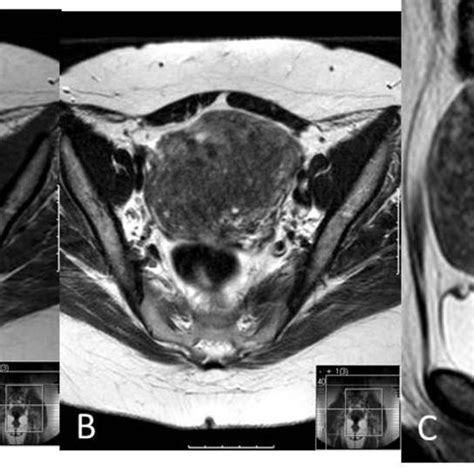 leiomyoma on mri pelvic mri axial t1 a and sagittal t2 b weighted download scientific