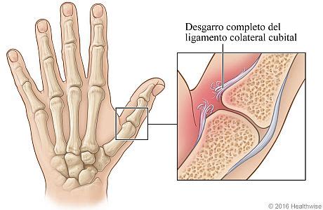 Pulgar De Esquiador O De Guardabosques Cigna