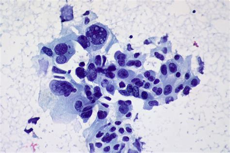 Non Small Cell Cancer Of The Lung