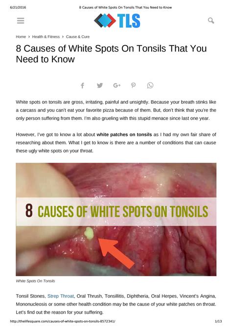 8 Causes Of White Spots On Tonsils You May Not Know By The