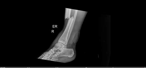 Tibia Shaft Fracture — Chicago Foot And Ankle Orthopaedic Surgeons