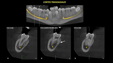 Caso Clinico N 717 RADIX ENTOMOLARIS Y PARAMOLARIS CDI Perú