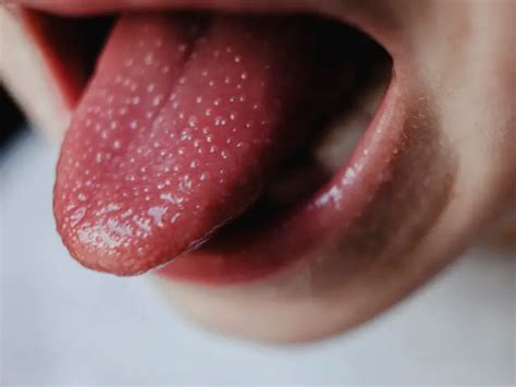 Swollen Taste Buds 10 Important Causes Diagnosis Treatment Sleck