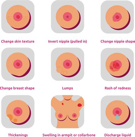 A breast lump is a bump or bulge of swelling tissue. Fibroadenoma