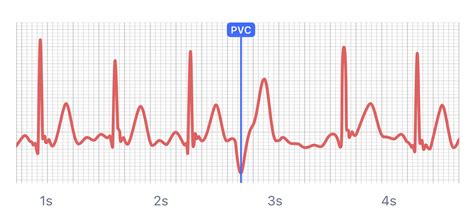What Premature Ventricular Contraction Pvc Looks Like On Your Watch