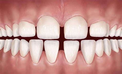 علاج فراغات الأسنان بدون تقويم، أسبابه والطرق المختلفة للعلاج Capital Dental Clinic