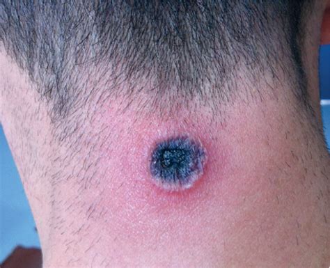 Figure 1 From Cutaneous Anthrax On An Unexpected Area Of Body