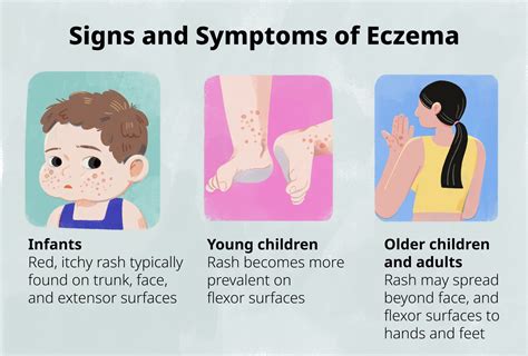 How To Identify Eczema In Children