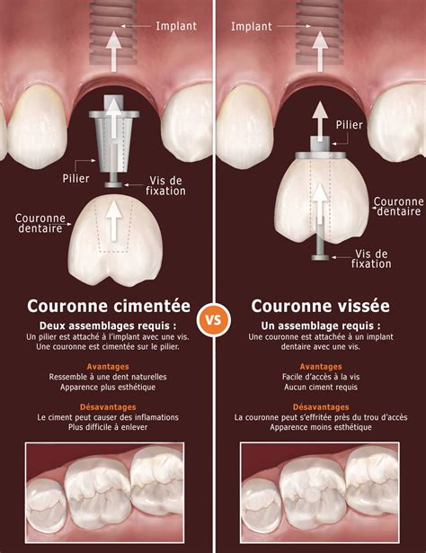 Couronne Sur Un Implant Dentaire Quelles Sont Les Options De Pose