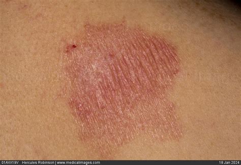 Stock Image Dermatology Psoriasis A Patch Of Pink Dry And Scaly Skin