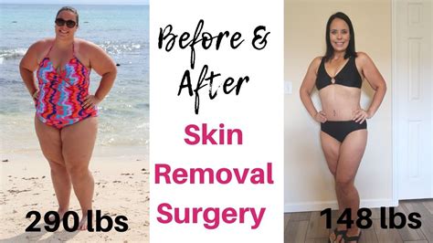 Before And After Pictures Of Excess Skin Removal