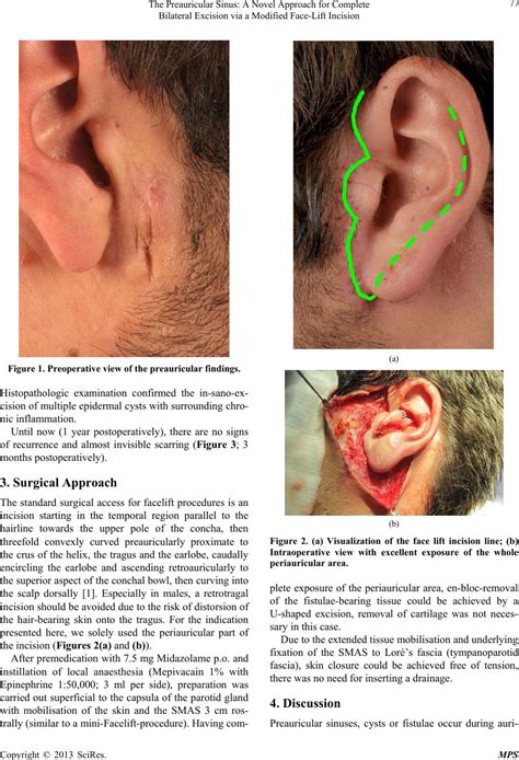 The Preauricular Sinus A Novel Approach For Complete Bilateral