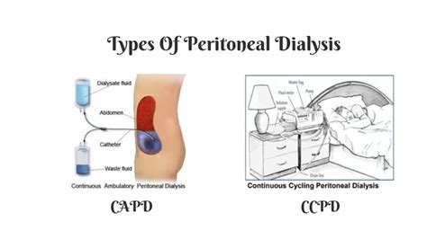 Peritoneal Dialysis Complications Is Peritoneal Dialysis For Me