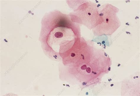 Lm Of Cervical Smear Revealing Hpv Infection Stock Image M Science Photo Library