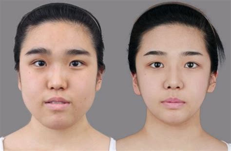 South Koreans Before And After Plastic Surgery Korean